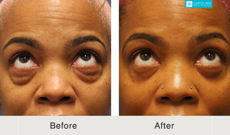 lower blepharoplasty before and after results in Charlotte, NC