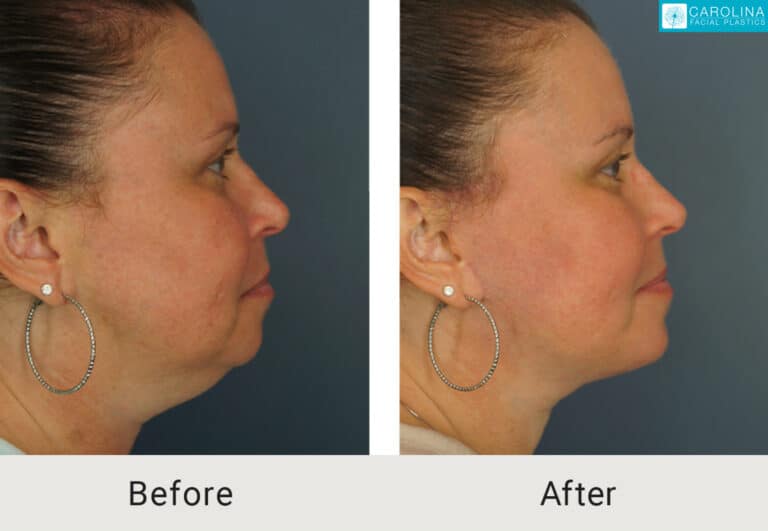 lower facelift and necklift results on a female patient from charlotte