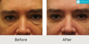 Lower-blepharoplasty-with-fat-grafting-to-eyes-and-cheeks-Kulbersh-Charlotte-1