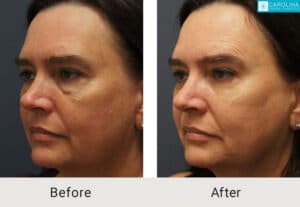 Lower-blepharoplasty-with-fat-grafting-to-eyes-and-cheeks-Kulbersh-Charlotte-2