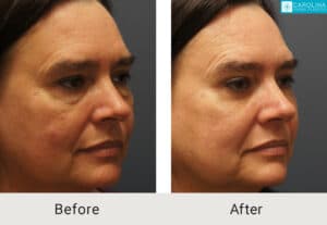 Lower-blepharoplasty-with-fat-grafting-to-eyes-and-cheeks-Kulbersh-Charlotte-3