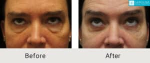Lower-blepharoplasty-with-fat-grafting-to-eyes-and-cheeks-Kulbersh-Charlotte