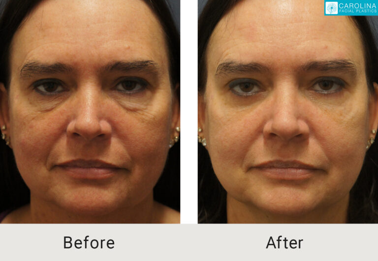 blepharoplasty results on a female patient