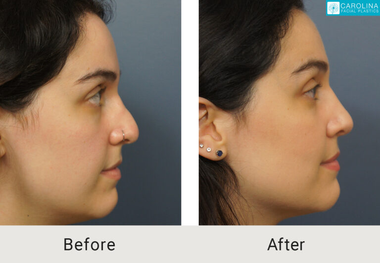 revision septorhinoplasty results