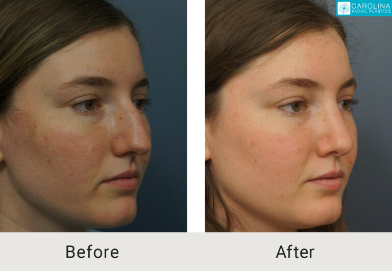 Patient before and after septorhinoplasty to correct deviated septom and improve nasal bridge in charlotte