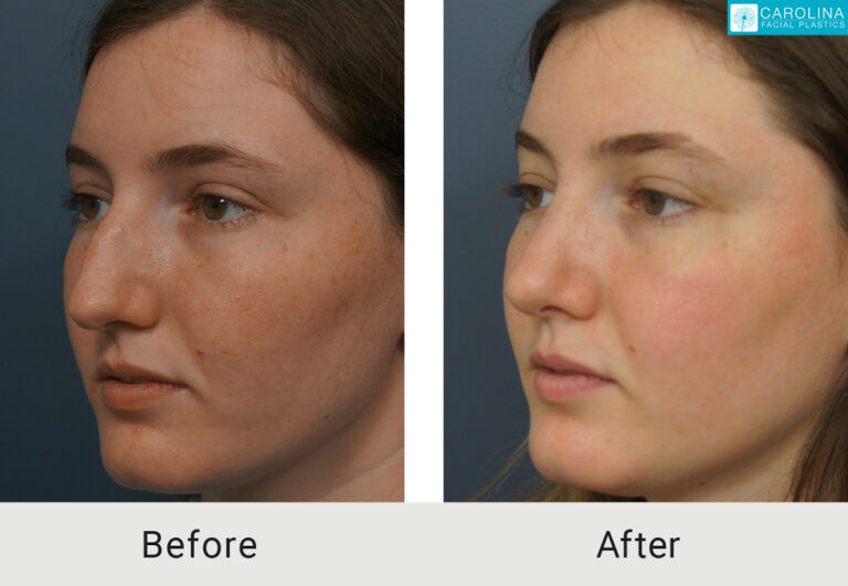 before and after septorhinoplasty to correct deviated septum