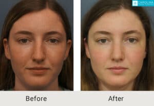 Septorhinoplasty-to-correct-deviated-septum-nasal-bridge-Kulbersh-Charlotte