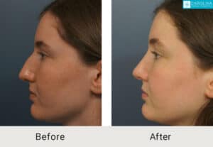 Septorhinoplasty-to-correct-deviated-septum-nasal-bridge-Kulbersh-Charlotte-4