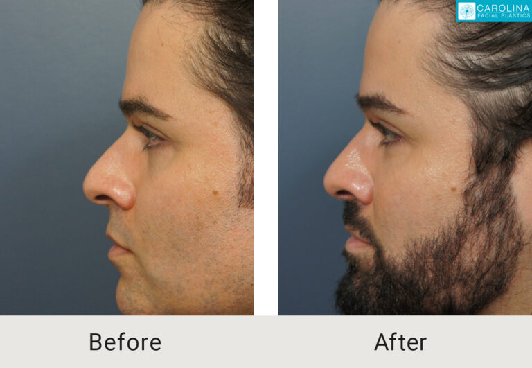 Male patient septorhinoplasty deviated septum correction before and after treatment in Charlotte
