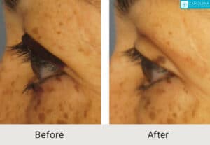 Upper Blepharoplasty-to-rejuvenate-the-eyes-Kulbersh-Charlotte-1
