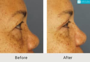 Upper Blepharoplasty-to-rejuvenate-the-eyes-Kulbersh-Charlotte-2