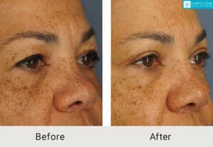 Upper Blepharoplasty-to-rejuvenate-the-eyes-Kulbersh-Charlotte-3