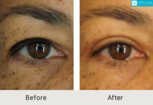 Upper Blepharoplasty-to-rejuvenate-the-eyes-Kulbersh-Charlotte