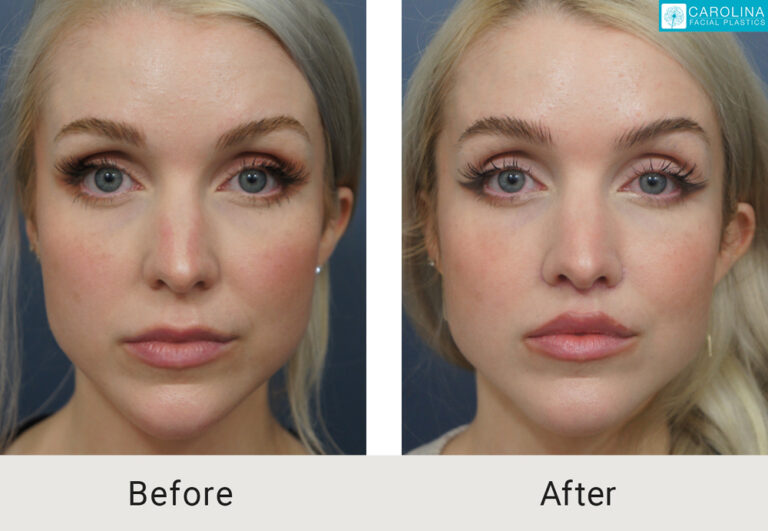 lip lift before and after