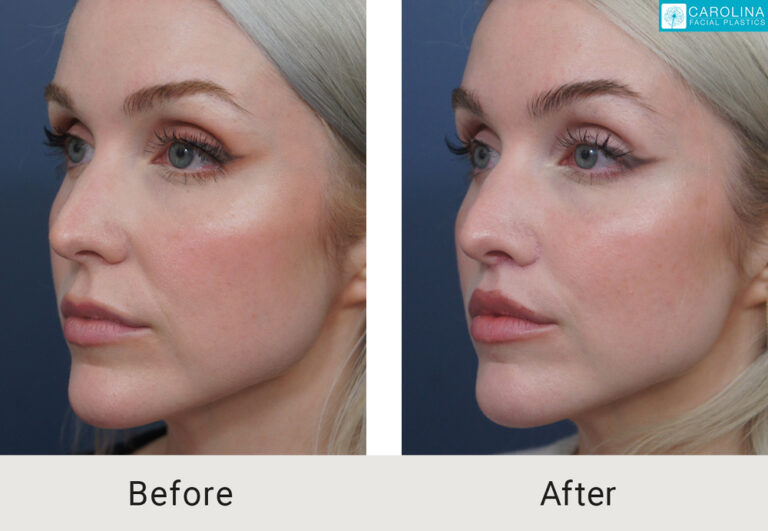 lip lift before and after