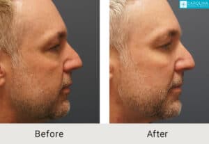 Lower-blepharoplasty-facial-fat-grafting-for-rejuvenation-Kulbersh-Charlotte-1