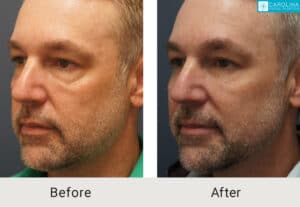 Lower-blepharoplasty-facial-fat-grafting-for-rejuvenation-Kulbersh-Charlotte-10