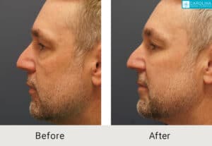 Lower-blepharoplasty-facial-fat-grafting-for-rejuvenation-Kulbersh-Charlotte-3