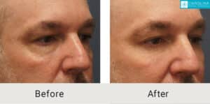 Lower-blepharoplasty-facial-fat-grafting-for-rejuvenation-Kulbersh-Charlotte