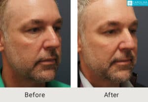 Lower-blepharoplasty-facial-fat-grafting-for-rejuvenation-Kulbersh-Charlotte-4