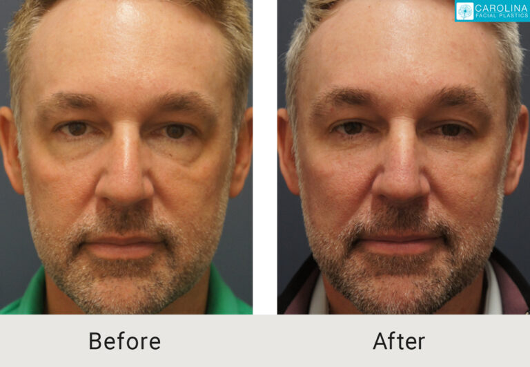 blepharoplasty before and after on a male patient