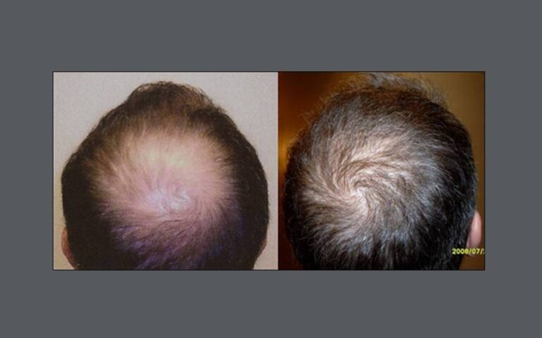 neograft hair transplants on a male patient