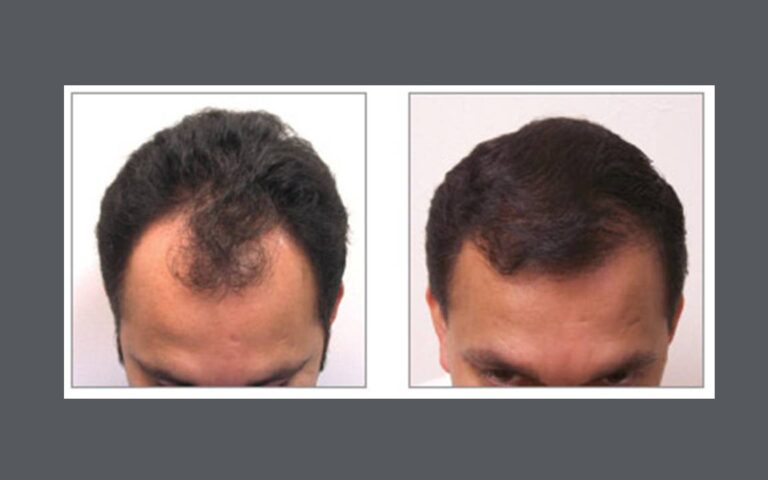 neograft hair transplant before and after