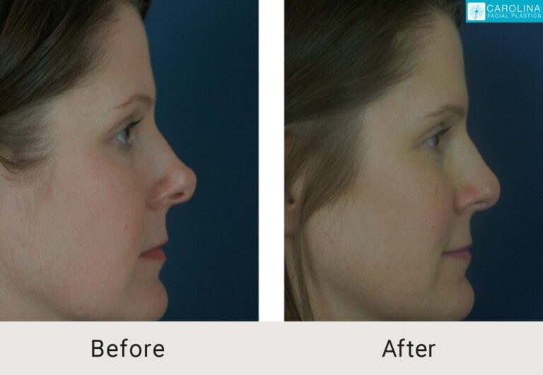 revision rhinoplasty results