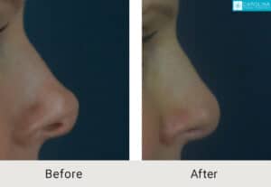 Kulbersh-Before-After-Revision-Rhinoplasty-Pinched-and-Asymmetrical-Tip-LARGE-06-05-2023- (3)