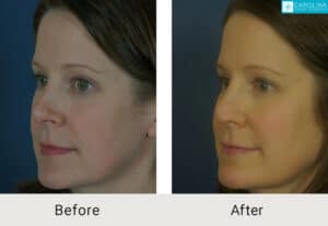 Kulbersh-Before-After-Revision-Rhinoplasty-Pinched-and-Asymmetrical-Tip-LARGE-06-05-2023- (4)