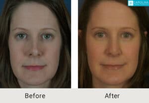 Kulbersh-Before-After-Revision-Rhinoplasty-Pinched-and-Asymmetrical-Tip-LARGE-06-05-2023- (6)