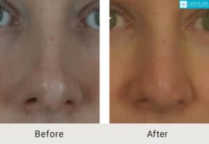 Kulbersh-Before-After-Revision-Rhinoplasty-Pinched-and-Asymmetrical-Tip-LARGE-06-05-2023- (7)