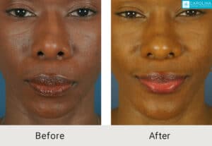 Kulbersh_Before-After-African_American_Revision_Rhinoplasty_w_Chin Implant_LARGE_06-1-2023-