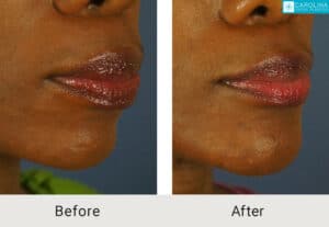 Kulbersh_Before-After-African_American_Revision_Rhinoplasty_w_Chin Implant_LARGE_06-1-2023-2