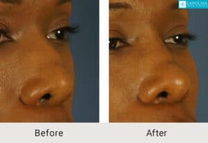 Kulbersh_Before-After-African_American_Revision_Rhinoplasty_w_Chin Implant_LARGE_06-1-2023-3