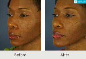 Kulbersh_Before-After-African_American_Revision_Rhinoplasty_w_Chin Implant_LARGE_06-1-2023-5