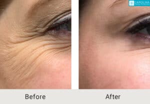 botox for crows feet before and after