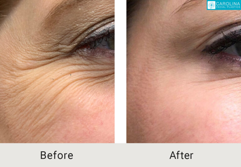 botox for crows feet before and after