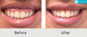 Kulbersh_Before-After-Botox-for-gummy-smile-CharlotteLARGE-06-06-20235