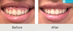 botox for gummy smile before and after