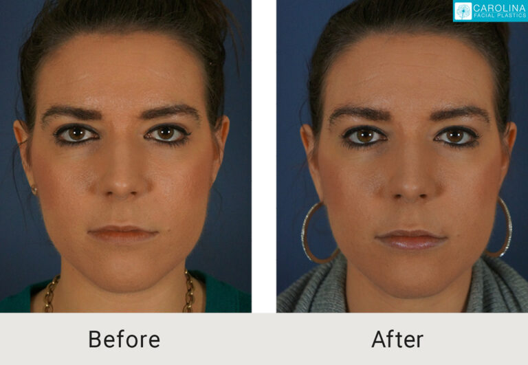 results of a lip augmentation procedure with lip fillers