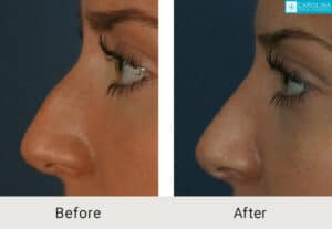 Kulbersh_Before-After-Charlotte-Teen-Rhinoplasty-for-Hump-LARGE_06-05-2023- (5)