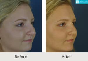 Kulbersh_Before-After-Charlotte-Teen-Rhinoplasty_LARGE_06-06-2023- (2)