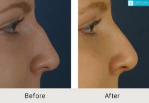 Kulbersh_Before-After-Charlotte-Teen-Rhinoplasty_LARGE_06-06-2023- (4)