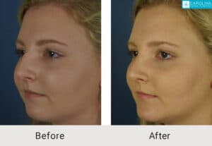 Kulbersh_Before-After-Charlotte-Teen-Rhinoplasty_LARGE_06-06-2023- (5)