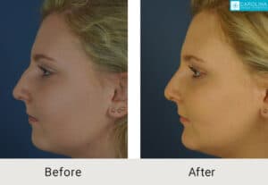 Kulbersh_Before-After-Charlotte-Teen-Rhinoplasty_LARGE_06-06-2023- (6)