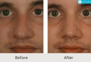 Kulbersh_Before-After-Droopy-tip-rhinoplasty-before-charlotte_LARGE_06-05-2023-2