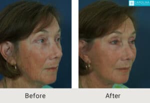 Kulbersh_Before-After-Facelift_with_Facial Fat_Grafting_LARGE_06-1-2023-