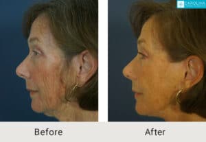 Kulbersh_Before-After-Facelift_with_Facial Fat_Grafting_LARGE_06-1-2023-4