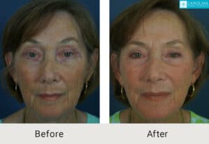 Kulbersh_Before-After-Facelift_with_Facial Fat_Grafting_LARGE_06-1-2023-5